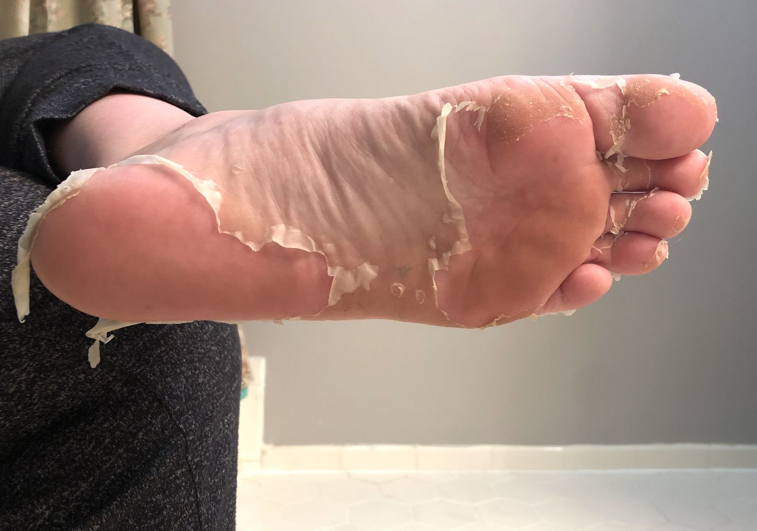 Foot with peeling skin