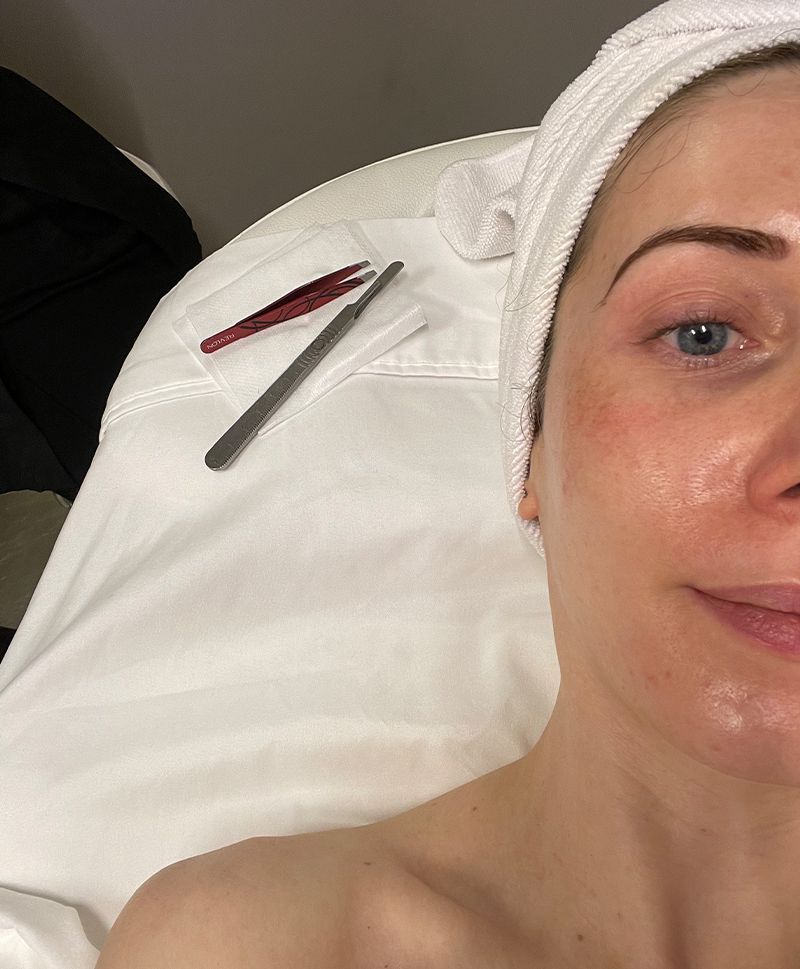 Byrdie writer Laura Lajiness receiving dermaplaning