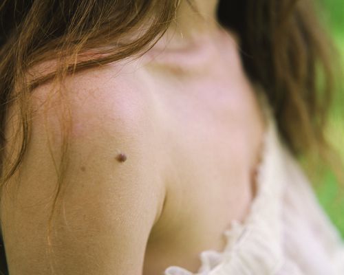 Woman with mole on shoulder