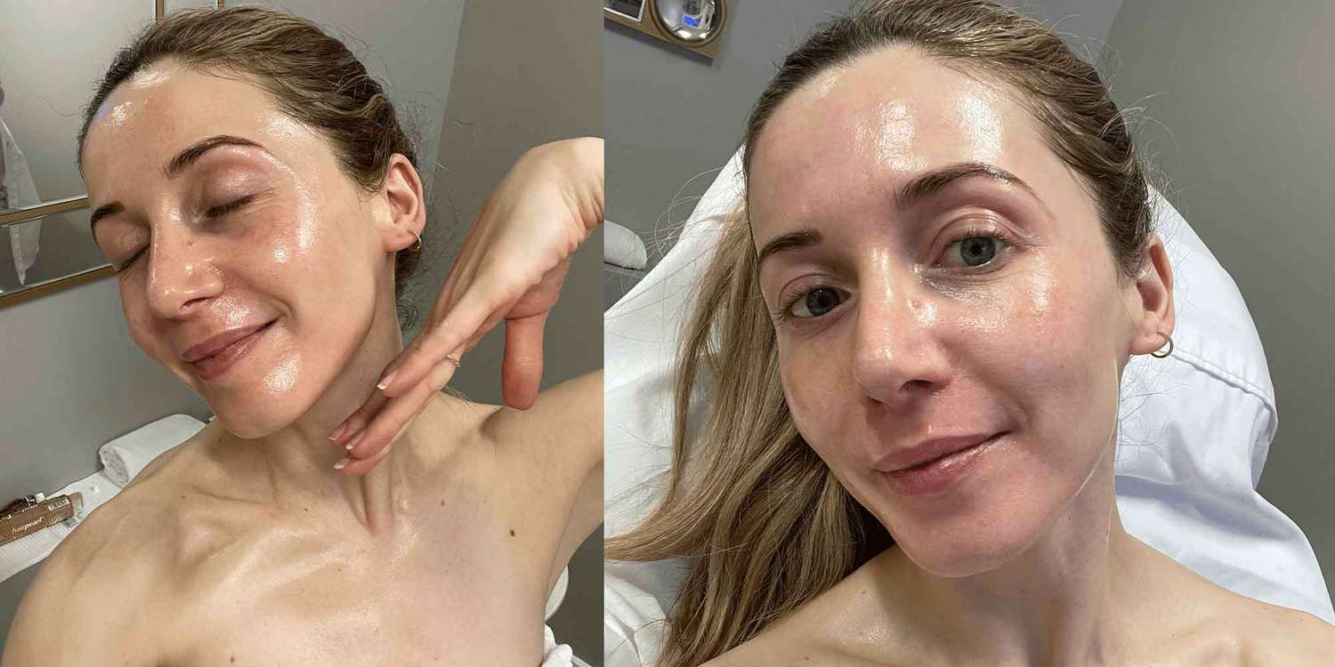 Byrdie writer Laura Lajiness's skin during a JetPeel facial