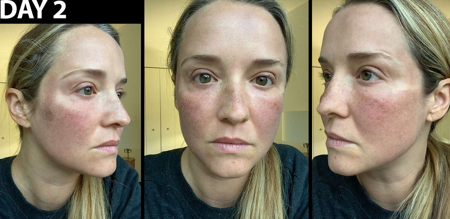 Writer's face with healing pigmentation the day after Fraxel laser treatment