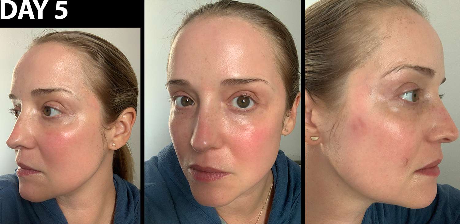 Writer's glowing, mostly healed face five days after Fraxel laser treatment