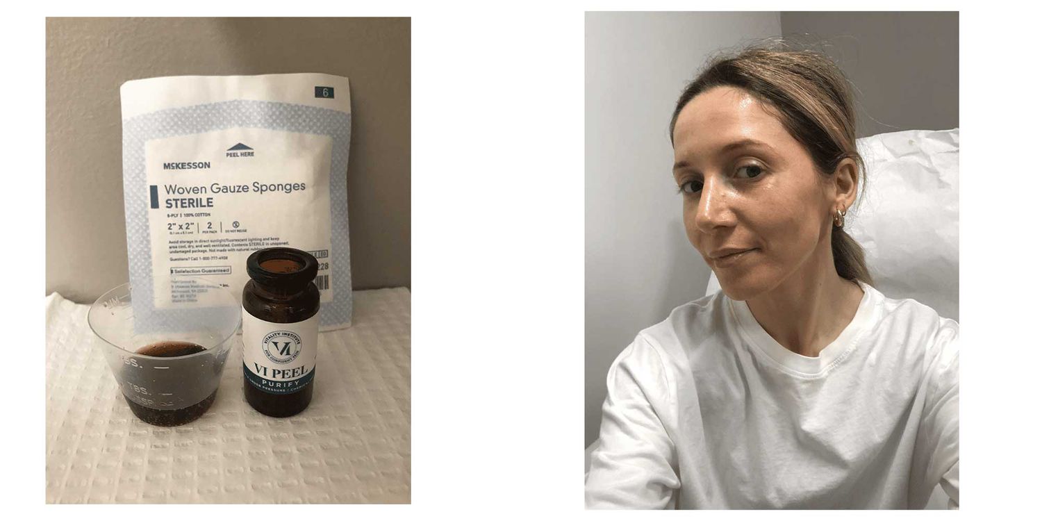 Byrdie writer Laura Lajiness receives the VI Peel skin treatment