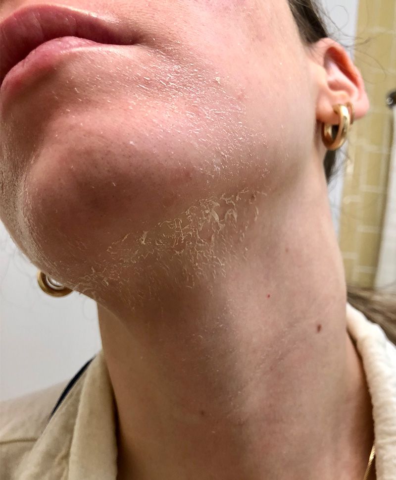 Byrdie writer Laura Lajiness's skin two days after receiving a chemical peel treatment