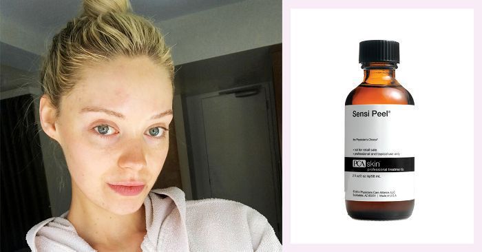 woman with clear skin side by side with pca skin sensi peel product