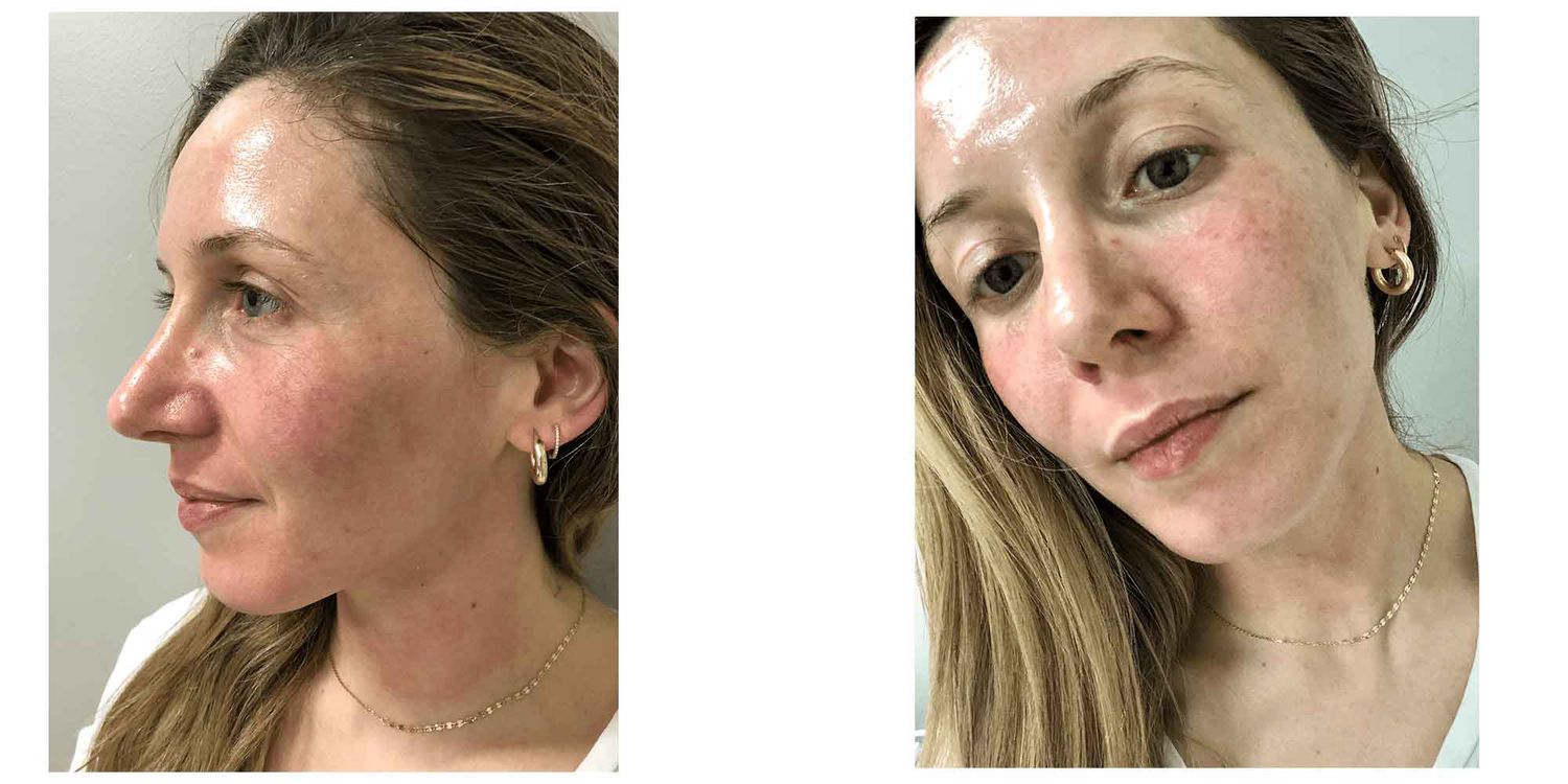 Byrdie writer Laura Lajiness before and after trying the Clear + Brilliant laser skin treatment