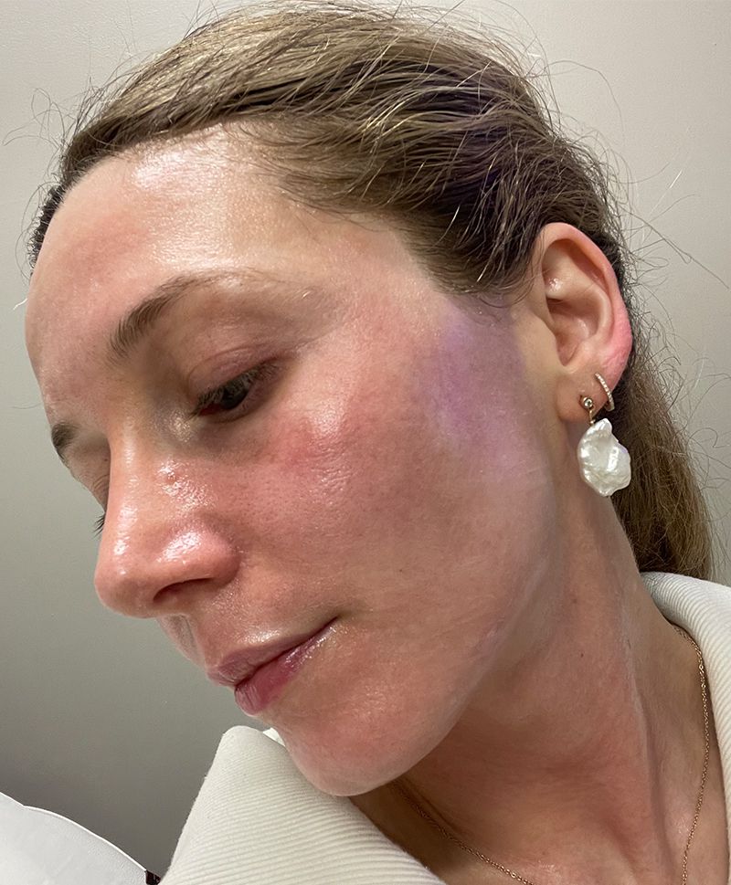 Byrdie writer Laura Lajiness's skin while receiving Laser Genesis and Vessel Removal treatments